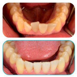 תמונות לפני ואחרי יישור שיניים שקוף