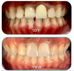 השתלת שיניים לפני ואחרי