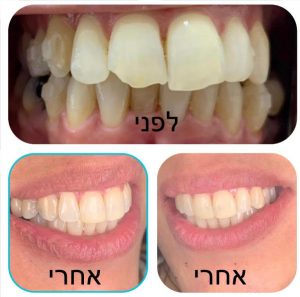 יישור שיניים שקוף -לפני ואחרי