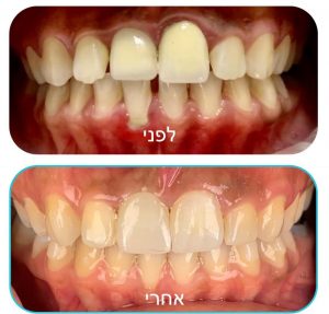 יישור שיניים שקוף -לפני ואחרי