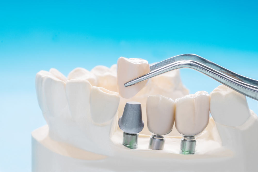 השתלת שיניים בזאלית למחוסרי עצם