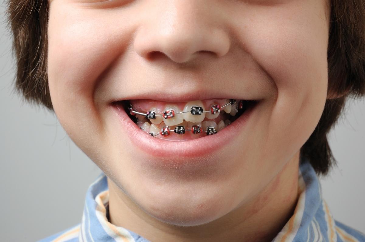 יישור שיניים לילדים מחיר