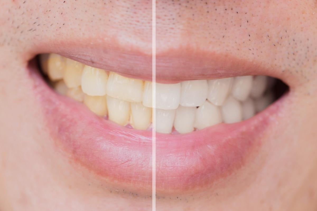 השתלת שיניים לפני ואחרי
