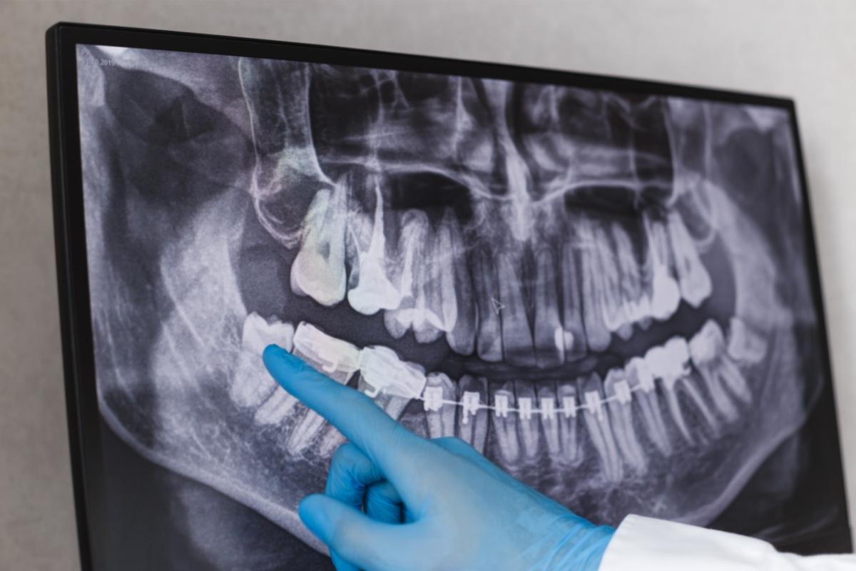 עקירת שן בינה כירורגית