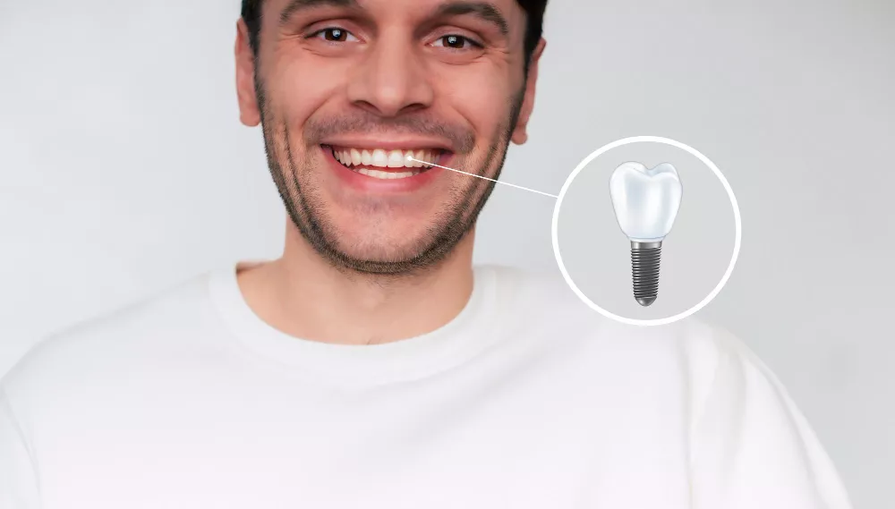 עלות השתלת שיניים בירושלים